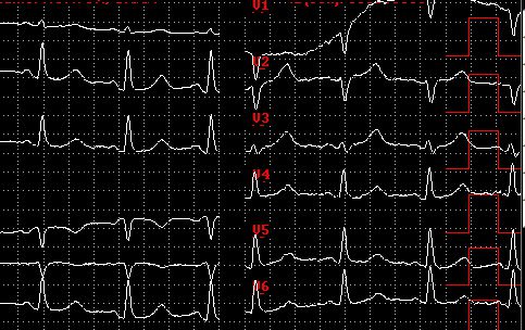 Ecg waveforms of a patient with a heart attack.
