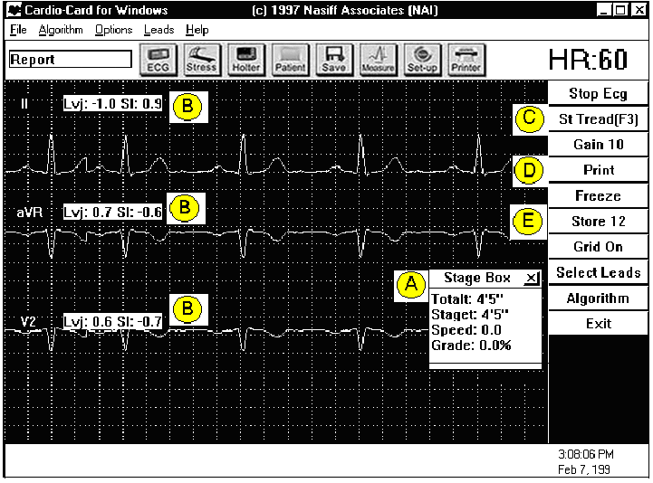 A computer screen showing an ecg screen.