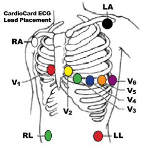 A diagram showing the placement of the cardiac card eg lead placement.